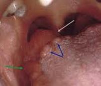Lingual tonsils Image