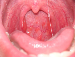 Sore Throat Image