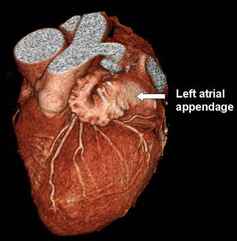 Left atrial appendage Picture