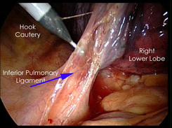 Pulmonary Ligament Image