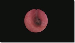 Intersphincteric groove Picture