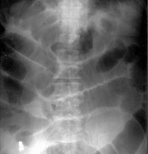 What is the treatment for ileus?